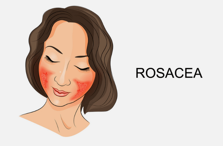 Rosacea on a girls face